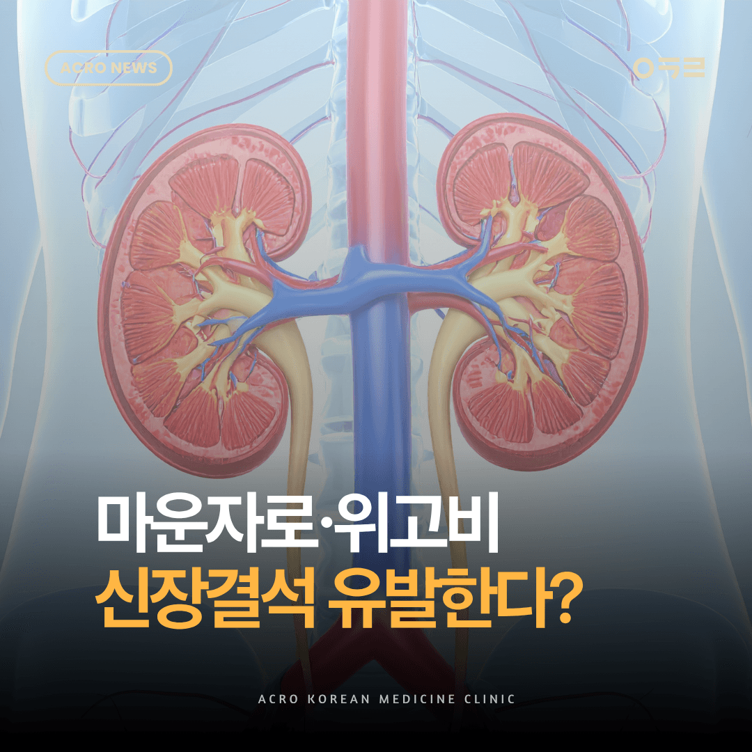 마운자로·위고비 신장결석 유발한다? 팩트체크
