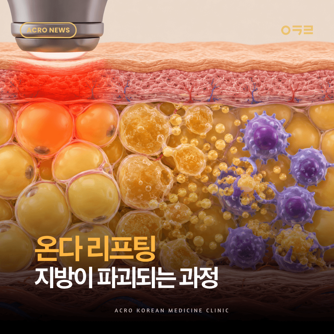 온다 리프팅 효과, 지방이 사라지는 과정