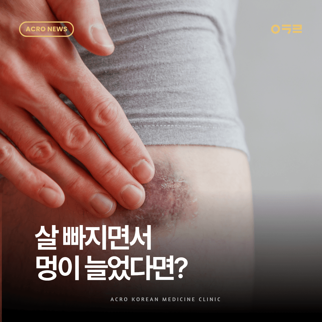 살 빠지면서 멍이 늘었다면?원인과 병원 가야 할 멍 구분