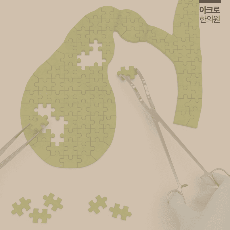 다이어트 담석증 위험을 줄이는 방법은?