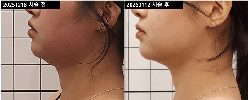 이중턱 극초단파 리프팅 2회 (1개월 후)