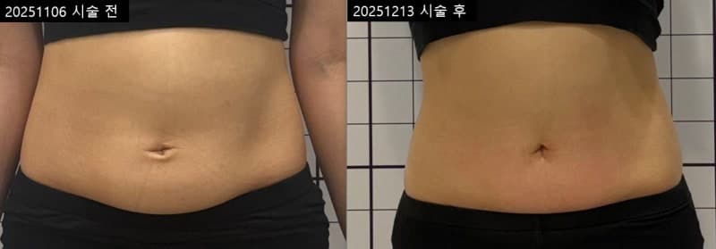 극초단파 리프팅 복부 2회 (25.11.06 ~ 25.12.13)