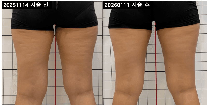 허벅지 라인 3회 (25.11.14 ~ 26.01.11)