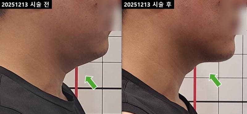 극초단파 리프팅 복부 당일 전후