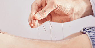 Spine Step 1. Acupuncture