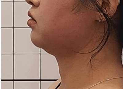 ACRO韓医院 二重あご オンダリフティング2回 施術前の写真