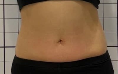 아크로한의원 복부 온다리프팅 2회 시술 후 정면 사진
