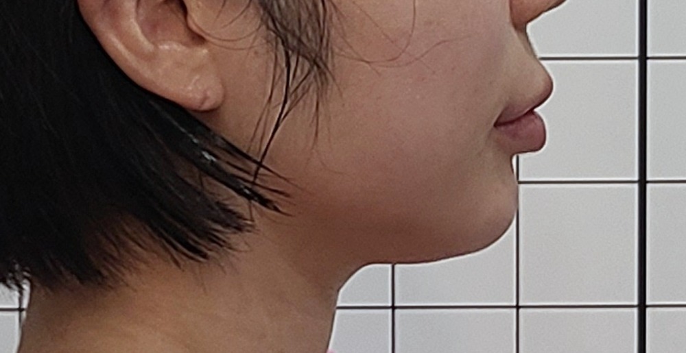 이중턱 온다리프팅 1회, 시술 당일