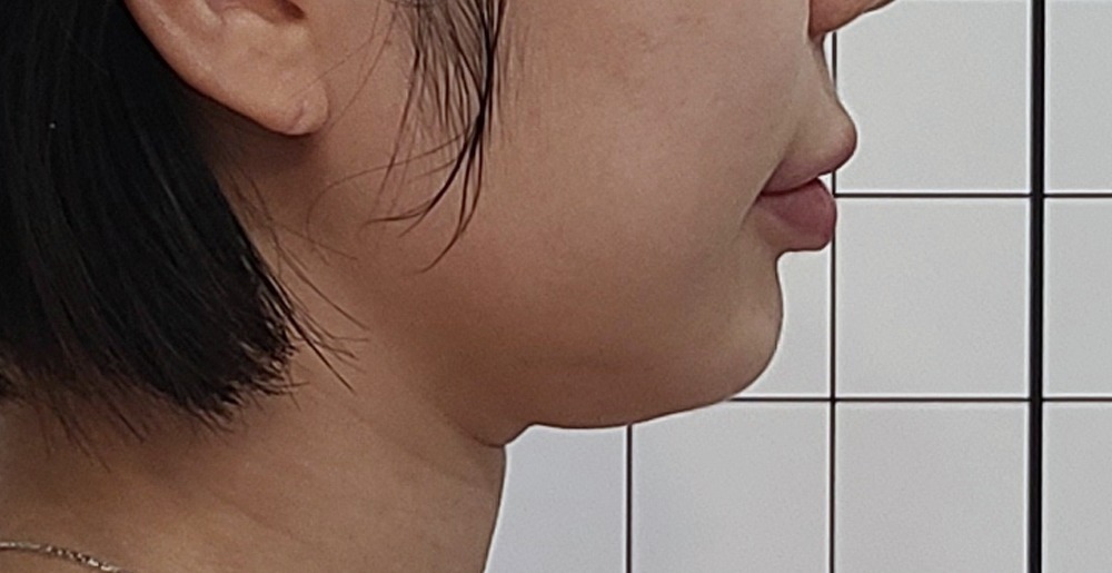 이중턱 온다리프팅 시술 전